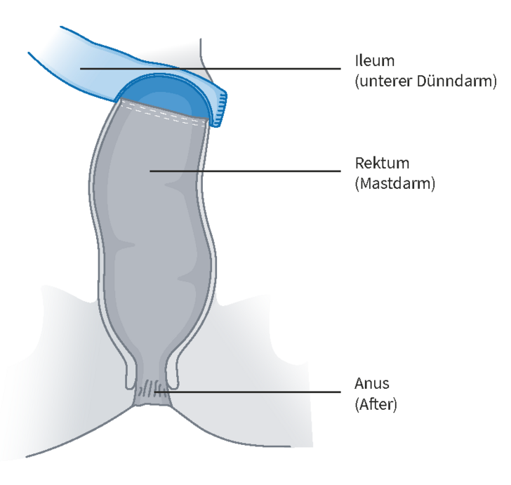 Grafische Darstellung unterer Dünndarm, Mastdarm und Anus mit Beschreibungen für die sogenannte Ileorektostomie im Amalie Pouch Zentrum Hamburg