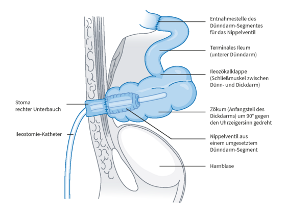 Grafische Darstellung kontinente Zökostomie mit Anfangsteil des Dickdarmes und Beschreibungen im Amalie Pouch Zentrum Hamburg