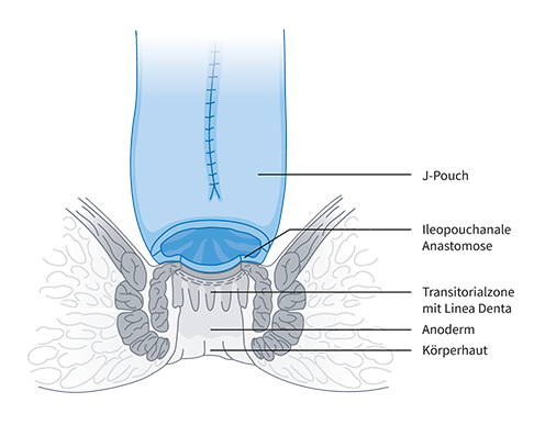 Grafische Illustration Ileopouch-anale Anastomose ohne Cuff bei Revisionseingriffen beim ileoanalen Pouch im spezialisierten Amalie Pouch Zentrum Hamburg.