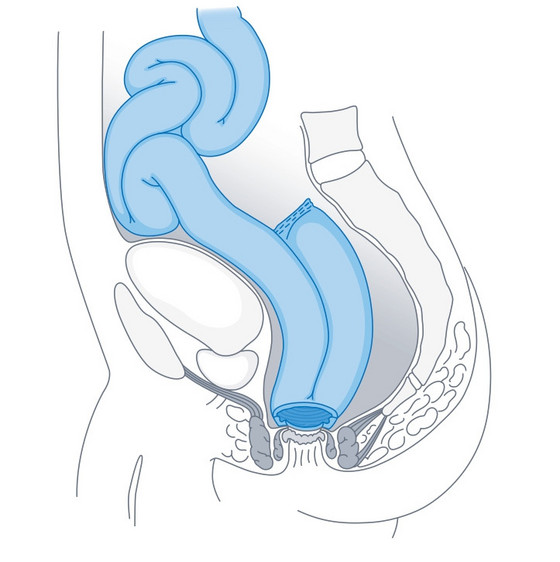 Grafische Illustration J-Pouch im sog. „kleinen Becken“ hinter der Harnblase und vor dem Kreuzbein aus dem Leistungsspektrum Ileoanaler Pouch im spezialisierten Amalie Pouch Zentrum in Hamburg