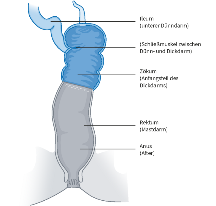 Grafische Darstellung unterer Dünndarm, Schließmuskel zwischen Dünn- und Dickdarm, Anfangsteil des Dickdarms, Rektum und Anus mit Beschreibungen für die sogenannte Zökorektostomie im Amalie Pouch Zentrum Hamburg