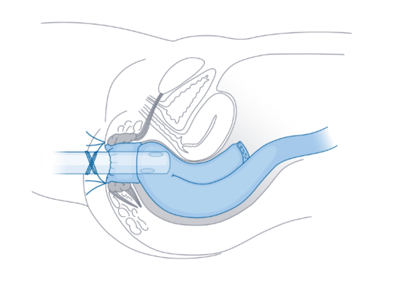 Grafische Illustration eines Katheters über den After in den J-Pouch zur vorübergehenden Stuhlableitung aus dem Leistungsspektrum Ileoanaler Pouch im spezialisierten Amalie Pouch Zentrum in Hamburg